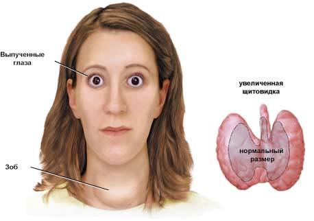 Болезнь Грейвса