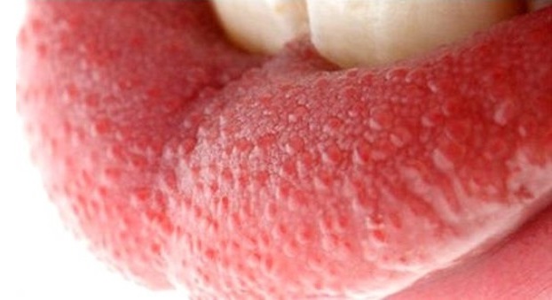 Воспаление языка (глоссит)