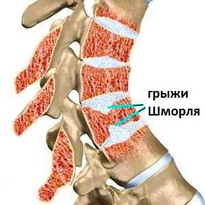 Грыжа Шморля (узлы Шморля)
