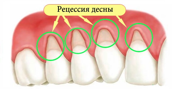 Рецессия десны