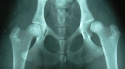 Вывих бедра