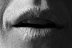 Сухость во рту (ксеростомия)