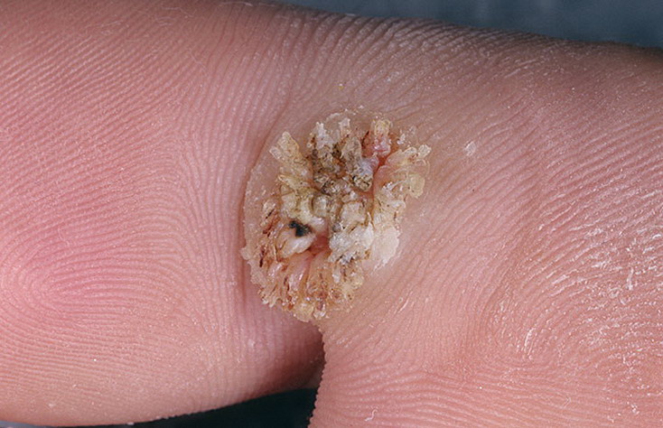 Вирусные бородавки