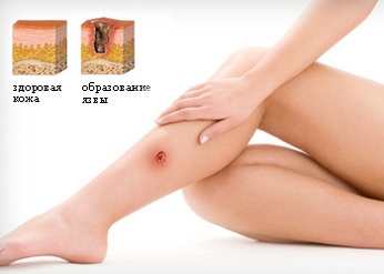 Трофическая язва