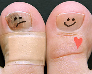 Онихомикоз (грибок ногтей)