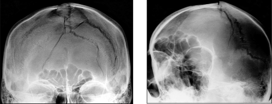 Перелом черепа