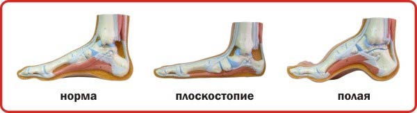 Полая стопа