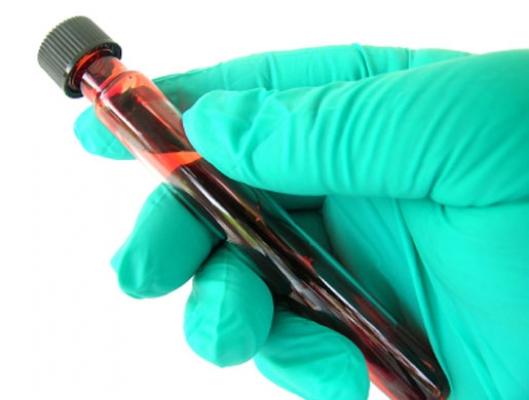 Волосатоклеточный лейкоз