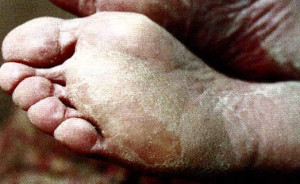 Рубромикоз