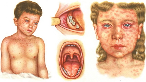 Лихорадка Ласса