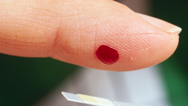 Макроглобулинемия Вальденстрема