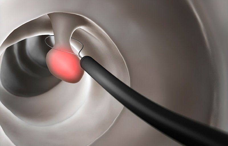 Полипы в носу