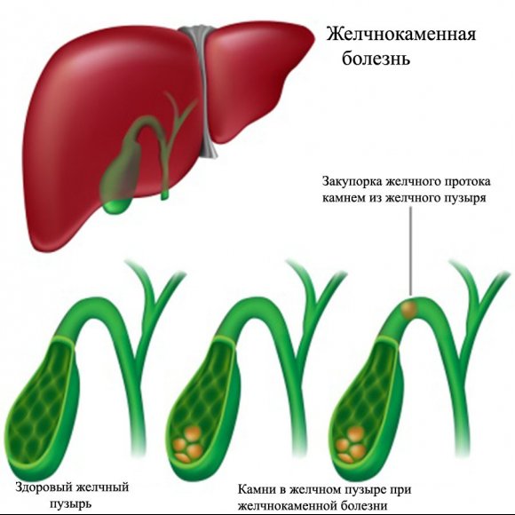 Колет в правом боку? 3 стадии желчнокаменной болезни