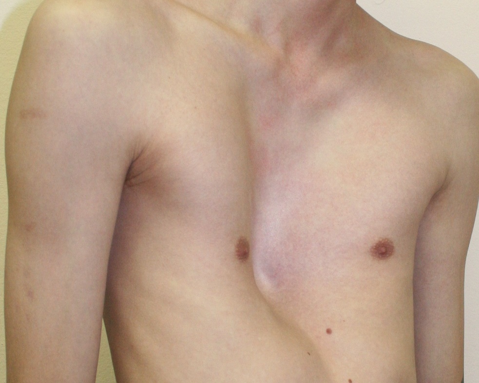 Деформация грудной клетки