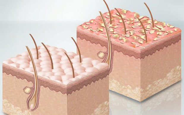 Себорейный дерматит