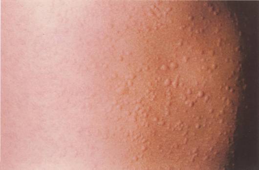 Солнечная крапивница