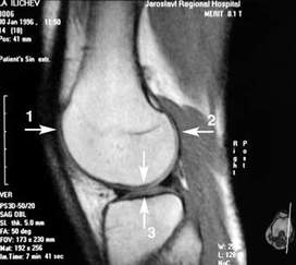 Препателлярный бурсит