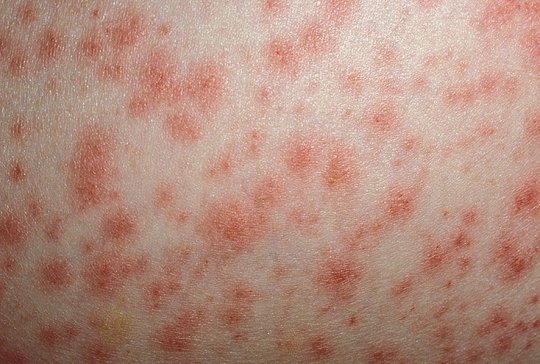 Как правильно лечить узловатую эритему?