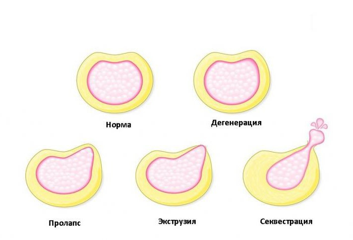 Протрузия шейного отдела: симптомы, лечение и прогноз