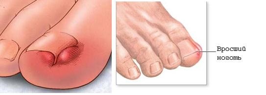 Вросший ноготь