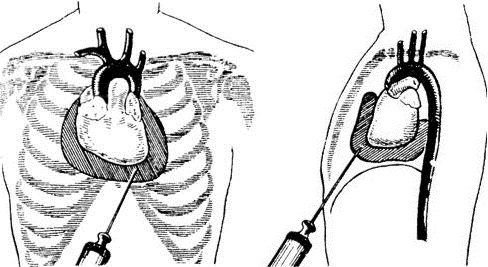 Гемоперикард
