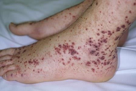 Тромбоцитопеническая пурпура