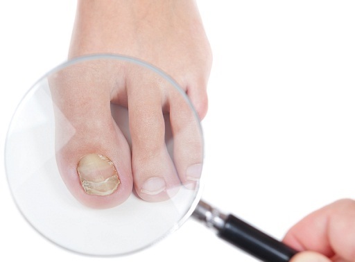 Дерматофития