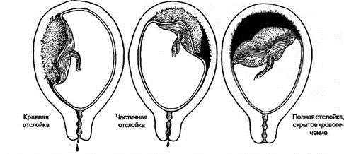 Преждевременная отслойка плаценты