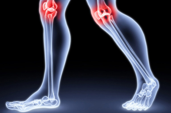 Псориатическая артропатия