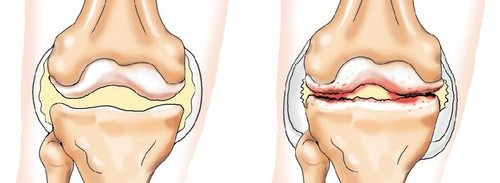 Болезнь Педжета