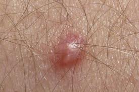 ВПЧ: вирус, который вызывает рак