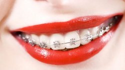 Что полезно знать о брекетах
