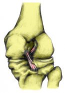 Разрыв задней крестообразной связки