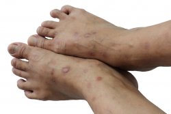 Лечение заболеваний кожи