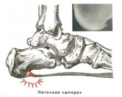 Шпора пяточная