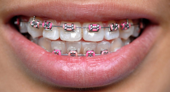 Как избавиться от неправильного прикуса
