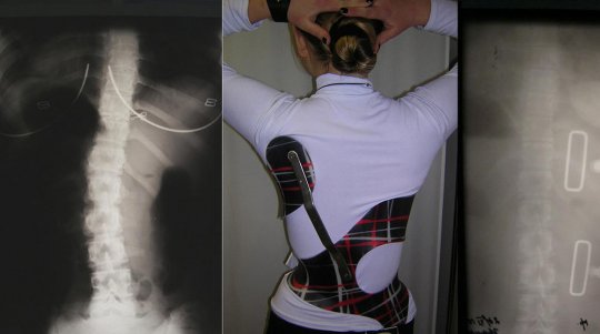 Методы лечения сколиоза. Что выбрать: корсет или операцию?