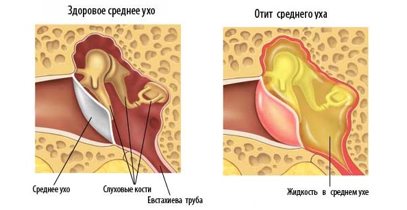 Острый средний отит