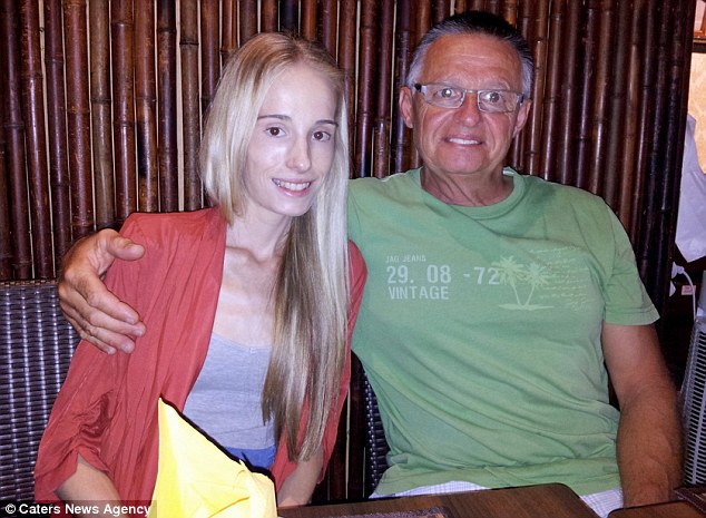 Девушка, которая весила 28 кг, показала свои фото в период анорексии