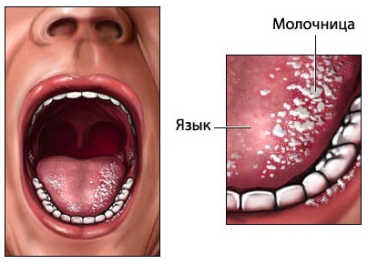 Кандидозный стоматит