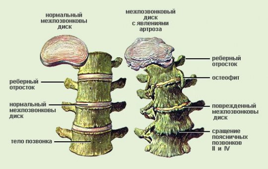 Классификация сколиоза по степени отклонения от нормы