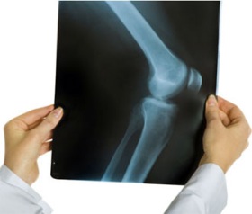 Периартрит коленного сустава