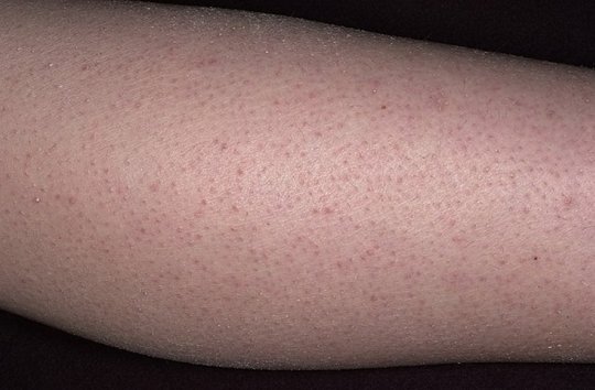 Мурашки по коже: сильные эмоции или симптом серьезного заболевания?