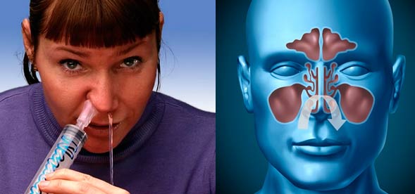 Вазомоторный ринит