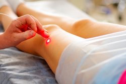 Лечение расширенных подкожных капилляров