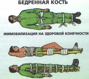 Перелом бедренной кости