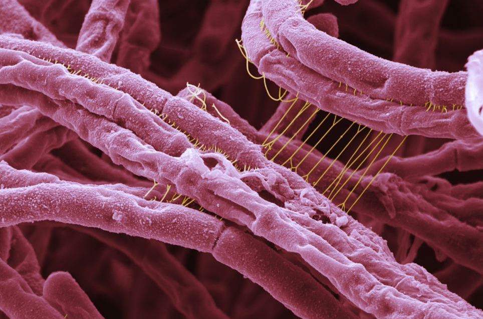 Сибирская язва