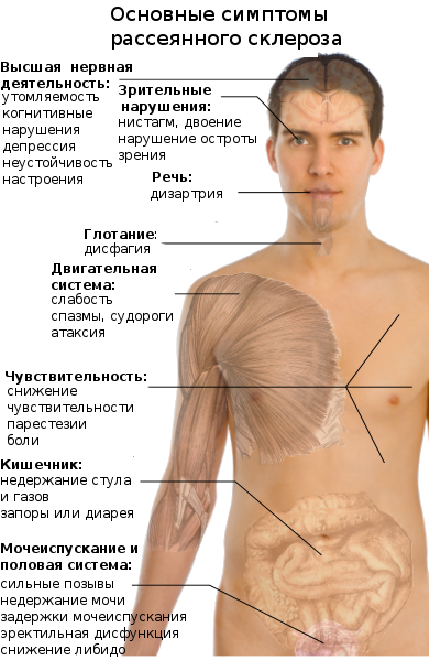 Лечение рассеянного склероза: как справиться с обострением и симптомами болезни