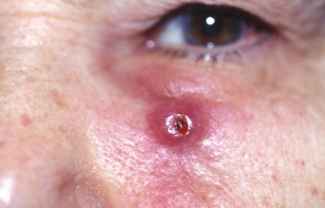 Карцинома кожи