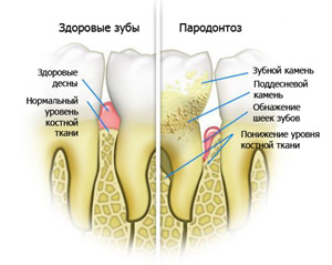 Пародонтоз